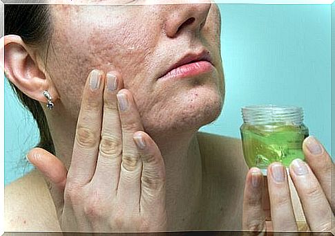 aloe vera to treat acne