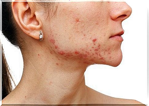 Anxiety symptoms: acne and skin problems