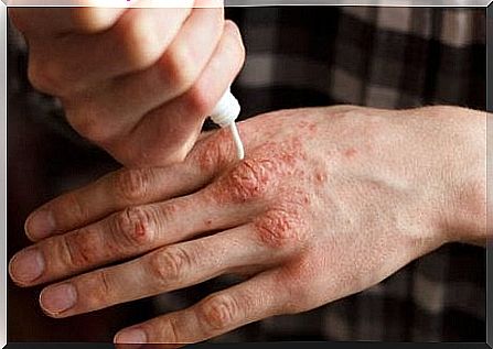 6 natural creams for psoriasis