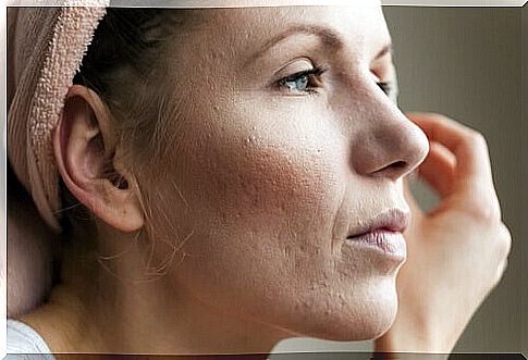 Too much cortisol causes skin problems