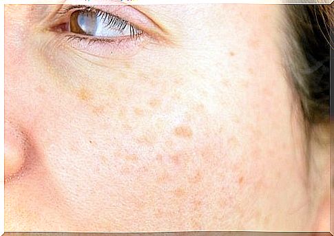 Skin pigment spots are a harmless but aesthetically disturbing skin defect