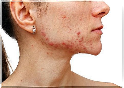 Hydrogen peroxide can also be used to treat inflammation and acne scars caused by acne