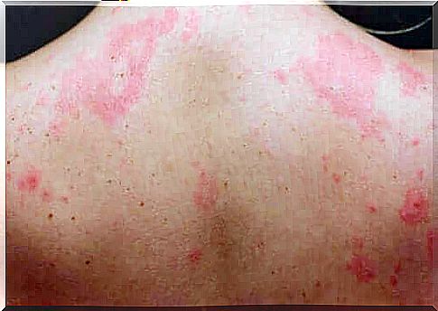 Chronic urticaria is when it persists for more than 6 weeks