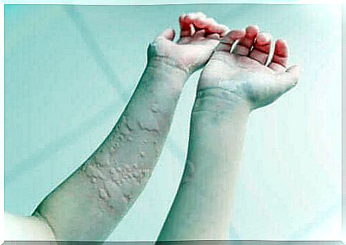 Chronic urticaria causes disturbing itching