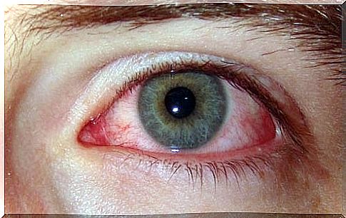 dry eye causes redness