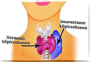 Enlarged thyroid gland