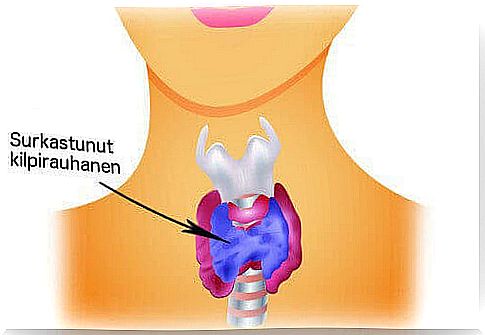 hypothyroidism