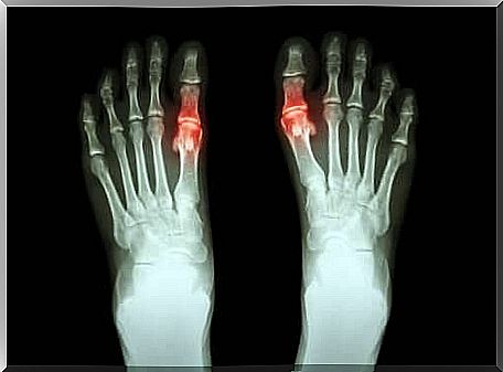 Gout usually affects men's feet in particular