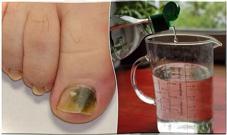 Get rid of nail fungus with this natural recipe