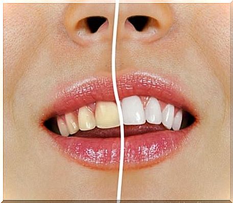 How to prevent tooth yellowing