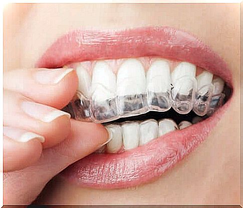 Thanks to small movements, invisible orthodontic treatment can in some cases achieve the desired results in even a shorter time than treatment with braces