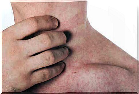 Latex allergy manifests as a rash.