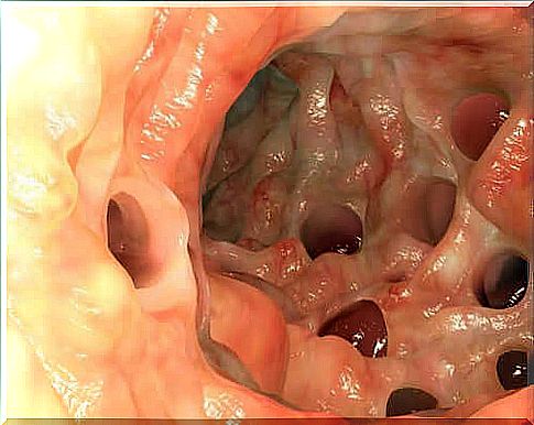 Meckel's diverticulum and its features