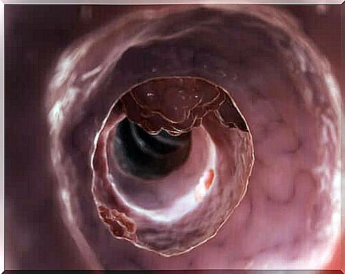 Meckel's diverticulum in the gut