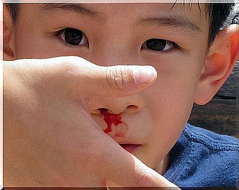 Nasal bleeding is a common ailment especially in children.