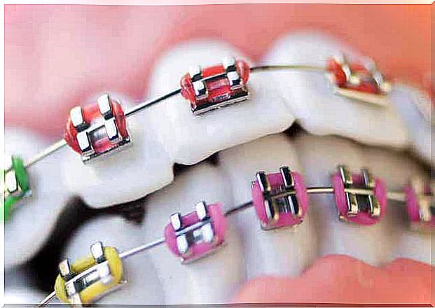 Orthodontics in children can be done with braces