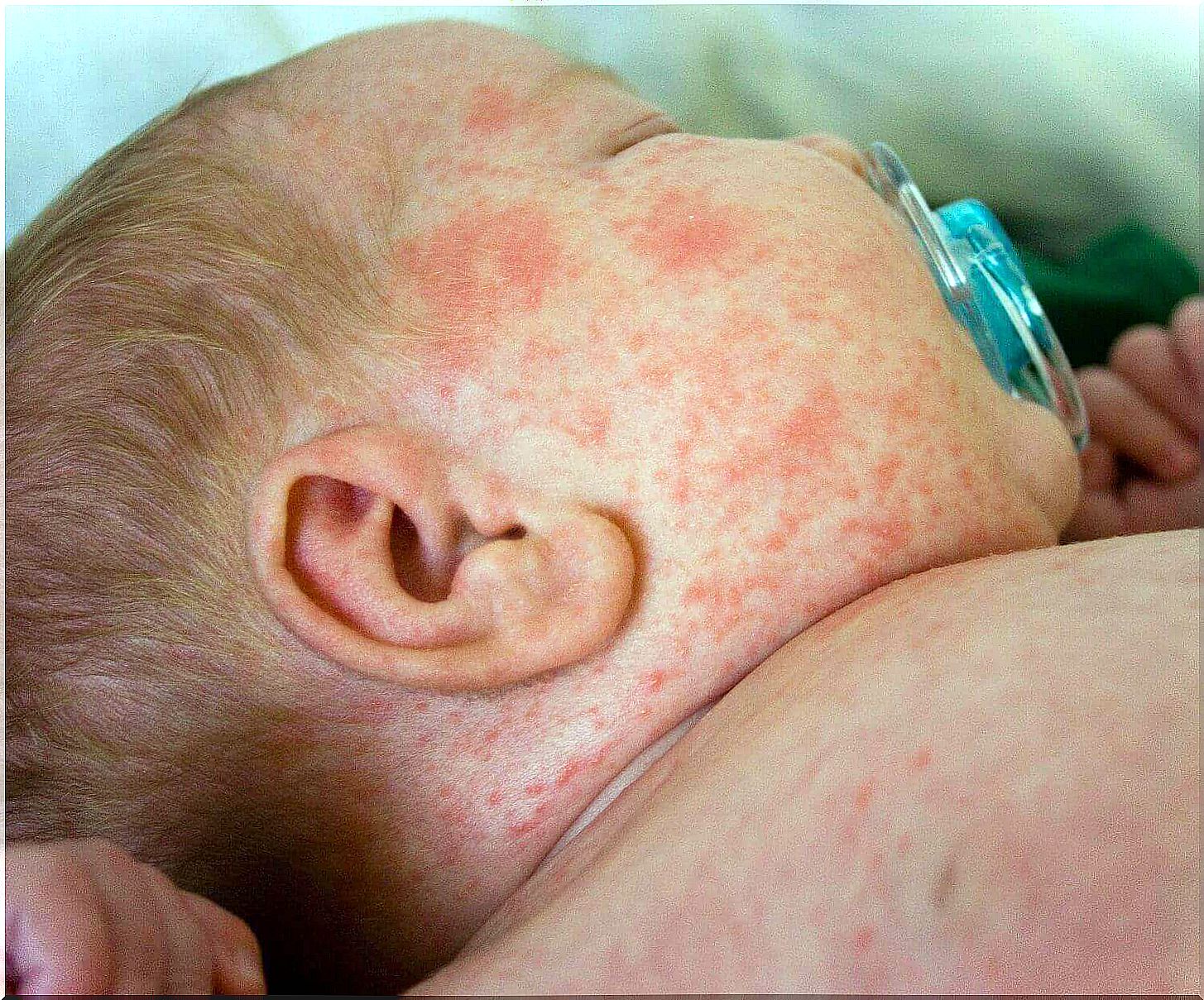 baby heat rash on the face