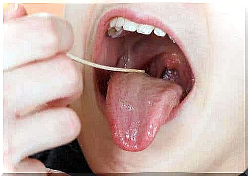 Symptoms of tonsillitis: red throat.