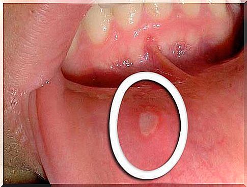 throat cancer can appear as mouth ulcers