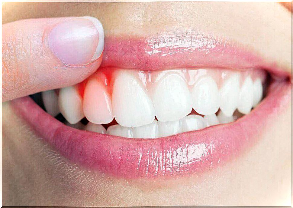 Top 5 Natural Remedies For Gingivitis