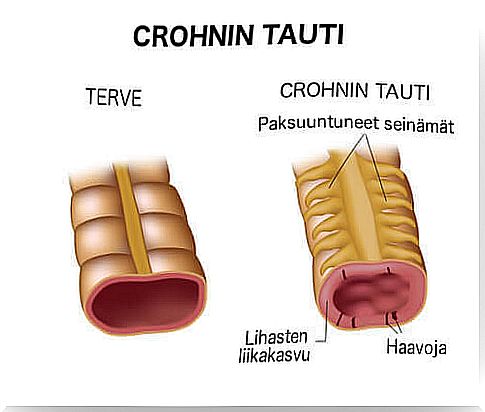 Treating Crohn's disease with the right diet