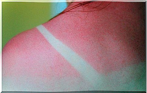 ginger has been used for sunburn